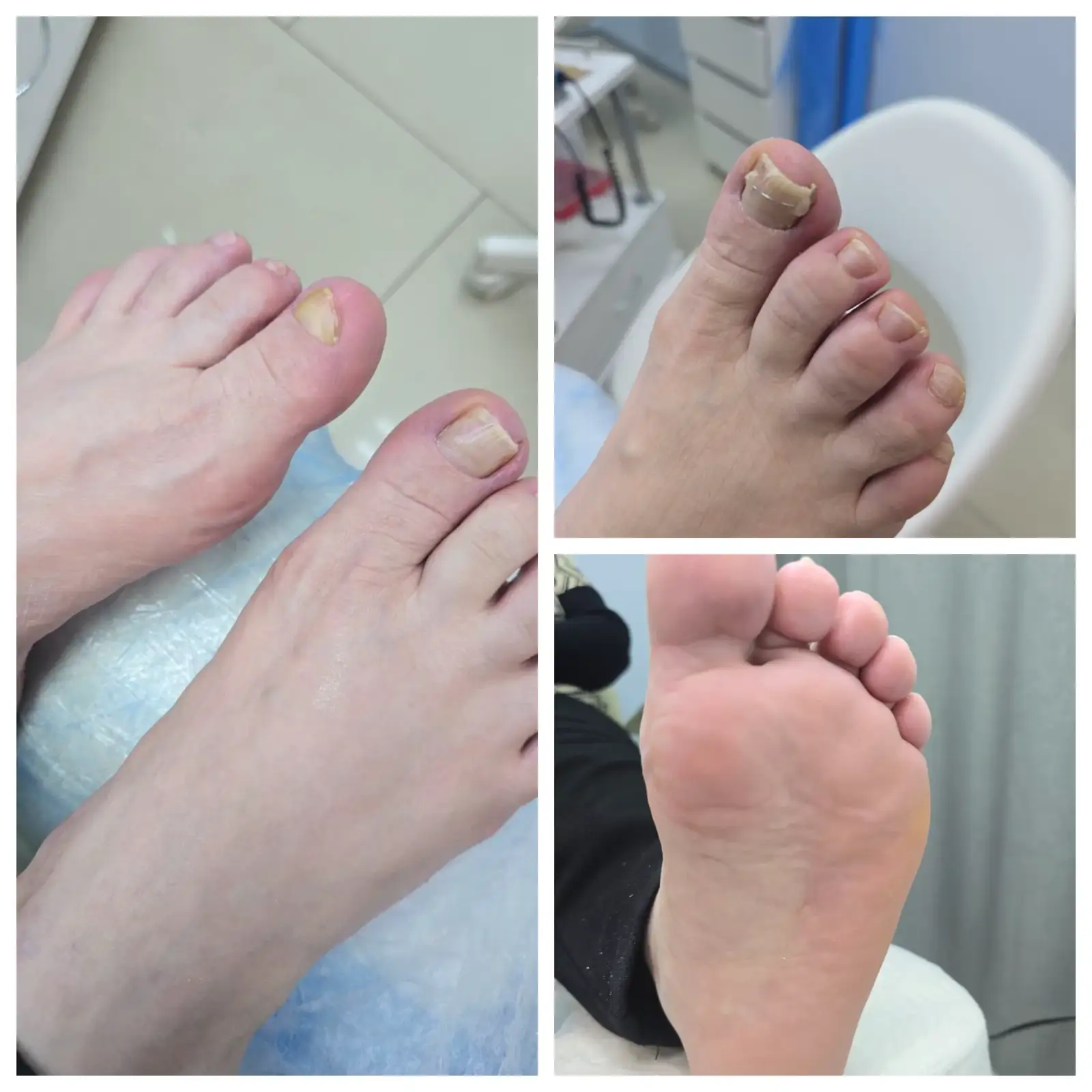 Подологический педикюр