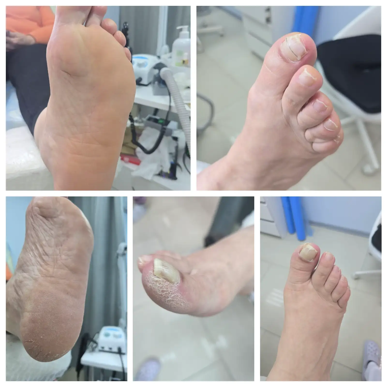 Зачистка онихолизиса